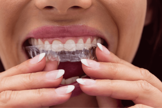 Attachments for Invisalign