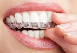 Diamond Invisalign Provider