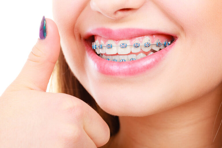 Orthodontic Facts