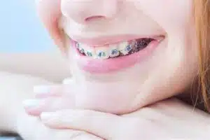 Orthodontic Facts