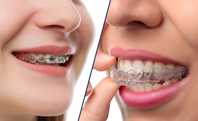 Teen Invisalign vs. Braces