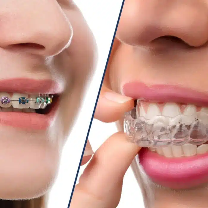 Teen Invisalign vs. Braces
