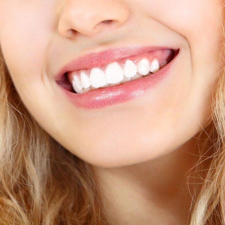 White Spots on Teeth After Braces