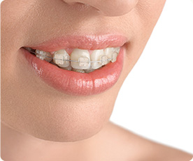 White Spots on Teeth After Braces