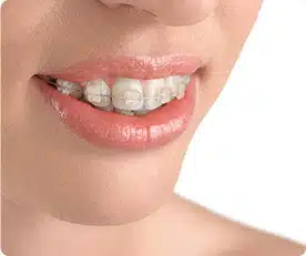 White Spots on Teeth After Braces
