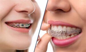Metal Braces vs. Clear Aligners