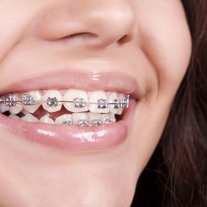Affordable braces options in Rocklin