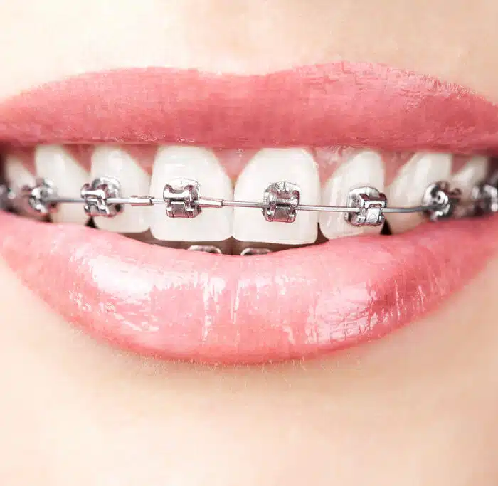 Braces for a perfect smile in Rocklin, CA