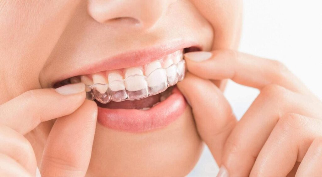 Close-up of a patient placing Invisalign clear aligners from a Granite Bay orthodontist