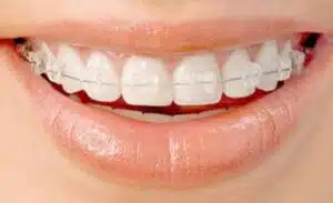 Clear braces designed for subtle orthodontic treatment