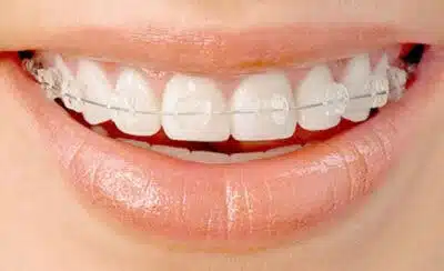 Clear braces designed for subtle orthodontic treatment