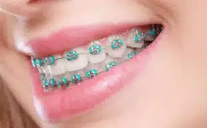 Close-up of ceramic braces blending with teeth