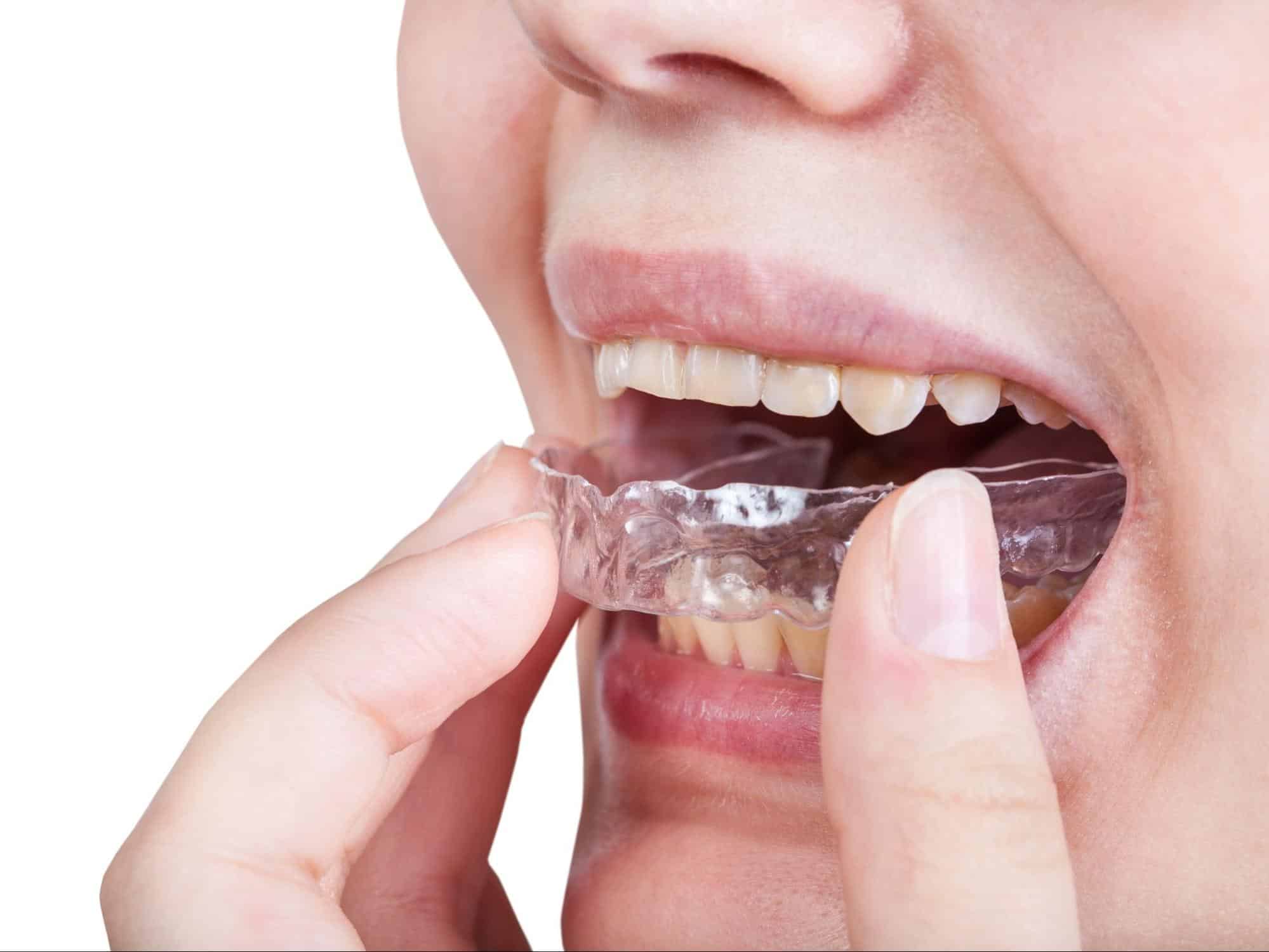 Adult patient wearing clear aligners at orthodontic office in Rocklin CA